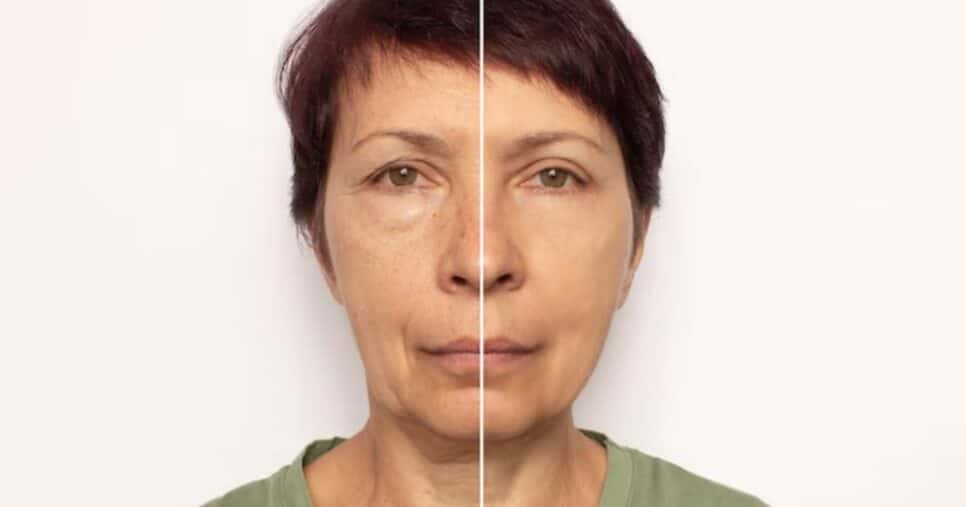 Antes e depois de rugas (Foto: Freepik)