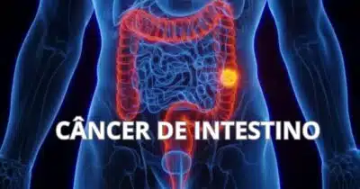 CÂNCER DE INTESTINO - Montagem TVFOCO