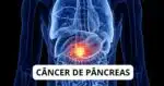 Câncer de pâncreas - Montagem TVFOCO