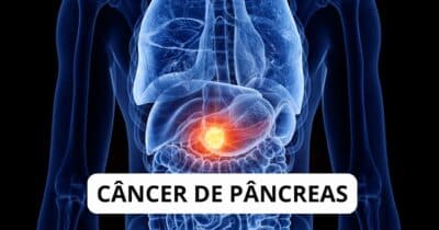 Câncer de pâncreas - Montagem TVFOCO