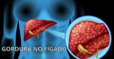 Gordura no fígado - Foto: Internet
