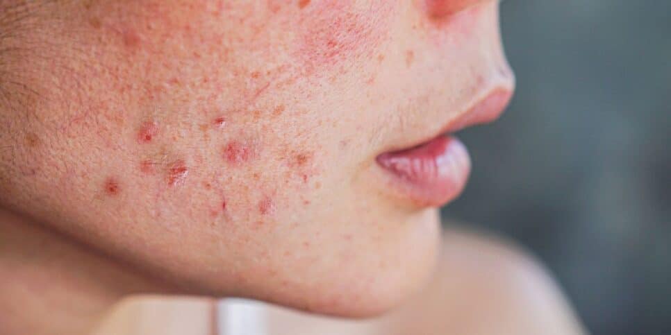 Mulher com acne (Foto: Canva)