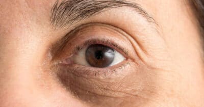 Médica revela método eficaz para se livrar de olheiras (Foto: Divulgação)