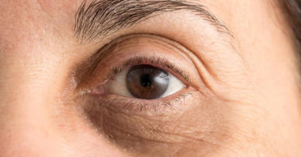 Médica revela método eficaz para se livrar de olheiras (Foto: Divulgação)