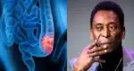 6 sintomas que indicam câncer no cólon como o de Pelé - Foto; Montagem