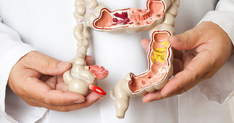 Sintomas de câncer no intestino (Foto: Reprodução)