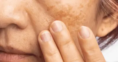 Como usar óleo natural que dá fim às manchas na pele e rejuvenesce idosos 60+