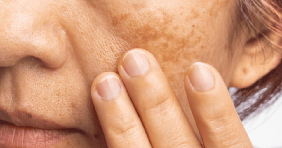 Manchas na pele chegam na menopausa - Foto: Internet