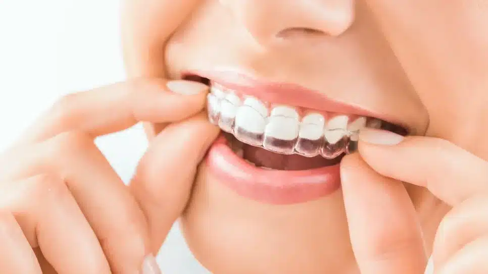 Tratamento com Invisalign (Foto: Reprodução/ Internet)
