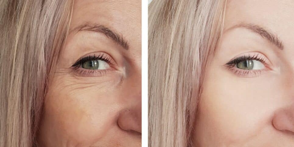 Antes e depois de rugas (Foto: Canva)