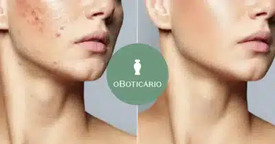 Antes e depois de pele ressecada e logo do Boticário (Fotos: Reproduções / Freepik / Internet)