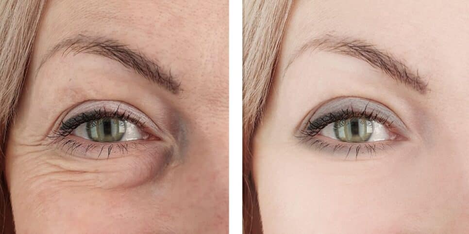 Antes e depois de rugas (Foto: Canva)