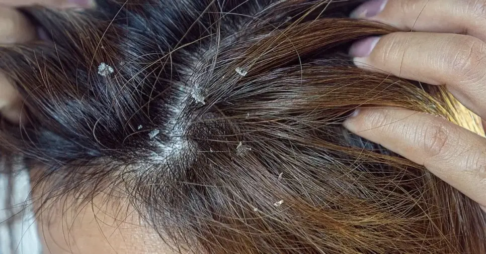 Cabelo com caspas (Foto: Divulgação) Cabelo com caspas (Foto: Divulgação)