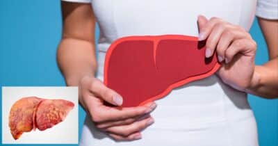 Descubra 5 passos para eliminar gordura no fígado com saúde (Foto: Reprodução/ Internet)
