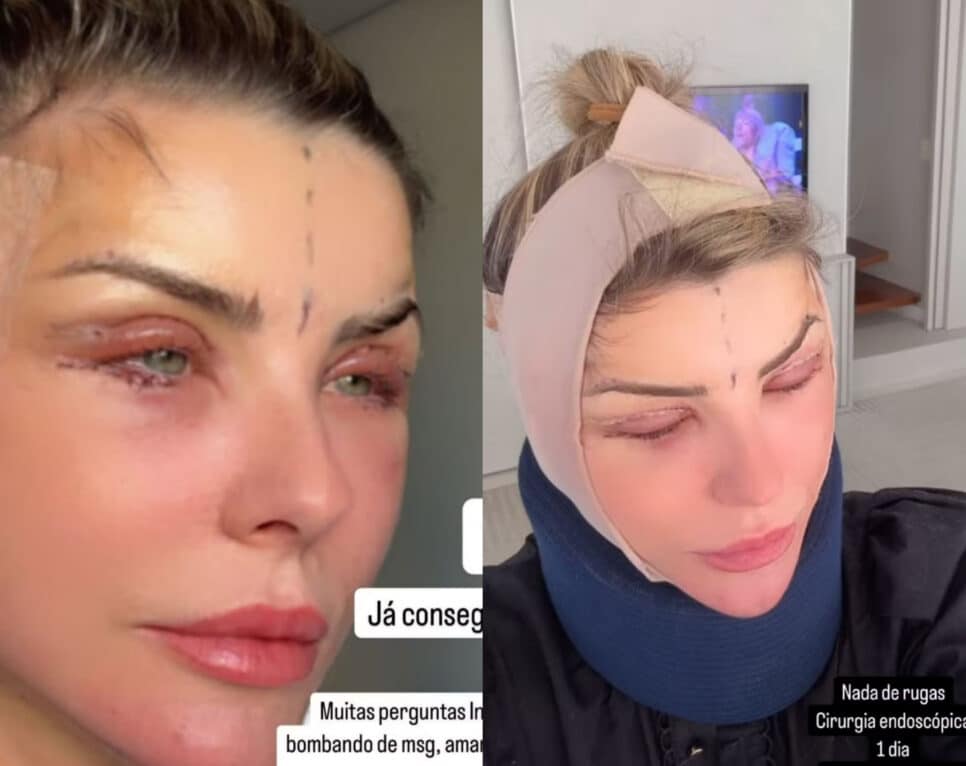 A famosa ex-BBB, Íris Stefanelli mostra resultado de cirurgia (Foto: Reprodução/Montagem TV Foco)