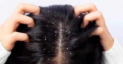 Mulher com caspa no cabelo (Foto: Reprodução)