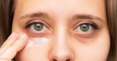 Nada de preenchimento: 7 passos simples pra camuflar as olheiras (Foto: Reprodução/ Internet)