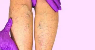 Óleo natural é capaz de acabar com as varizes e sumir com manchas