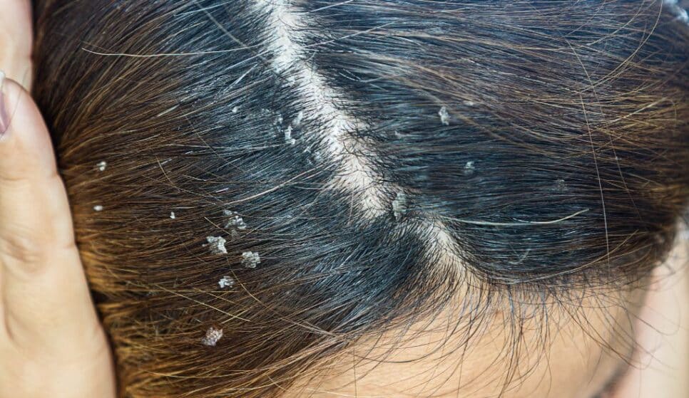 Cabelo com caspas (Foto: Divulgação)