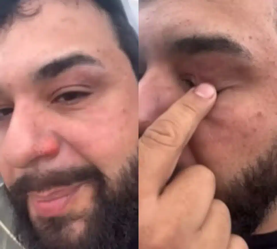 Músico sertanejo mostra como ficou o seu rosto após ser atingido pelo fogo (Foto: Reprodução/Montagem TV Foco)