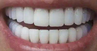 Dentes alinhados (Foto: Reprodução/ Internet)