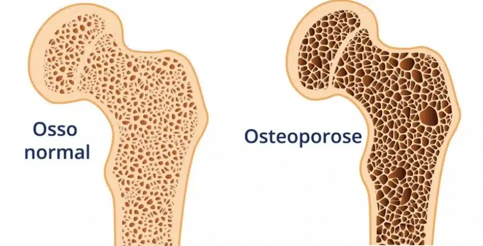 Sintomas da osteoporose (Foto: Reprodução/ Internet)