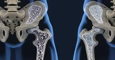 Sintomas da osteoporose (Foto: Reprodução/ Internet)