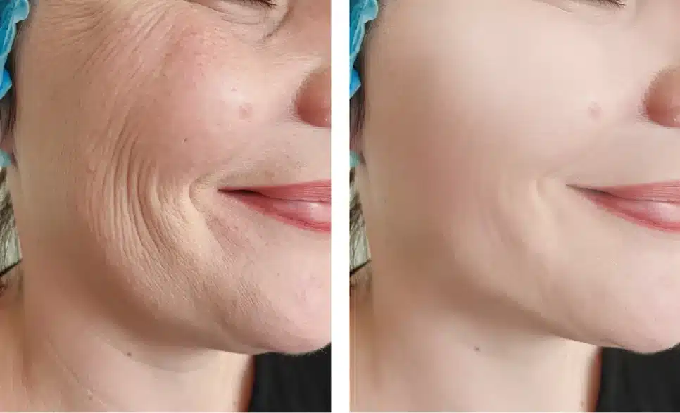 Efeitos de produtos a base de retinol na pele, antes e depois (Foto Reprodução/Montagem/YouTube)