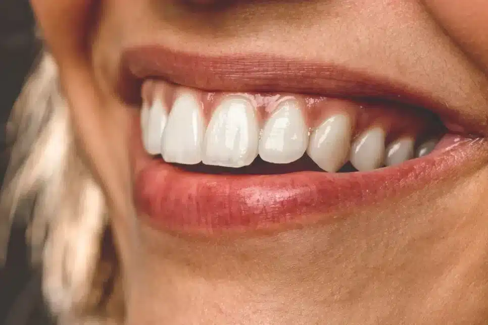 Dentes perfeitamente alinhados (Foto: Reprodução/ Internet)