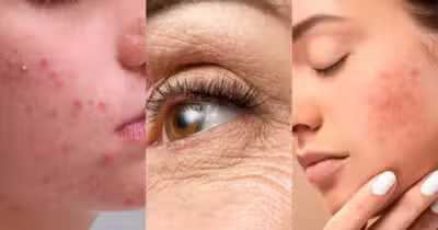 Ilustração de acne, rugas e manchas na pele (Foto: Reprodução/ Internet)