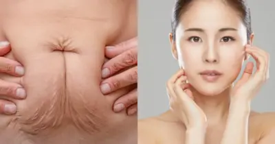 6 truques para acabar com a flacidez sem precisar de cirurgia plástica