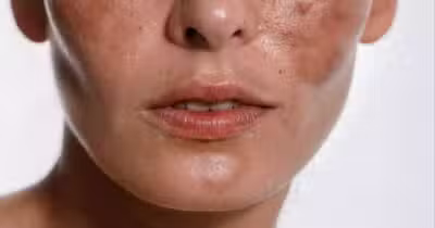 Mulher com manchas na pele do rosto (Foto: Reprodução/ Internet)