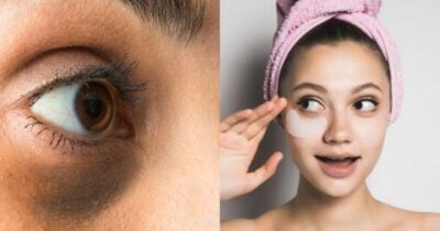Esses 6 passos simples acabam com as olheiras das mulheres (Foto: Reprodução/ Internet)