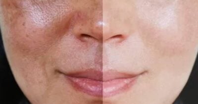 Técnica promete disfarçar às rugas e manchas do rosto das mulheres - Foto: Internet