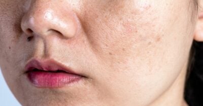Misturinha com 3 ingredientes traz botox natural e fim das rugas  - Foto: Internet