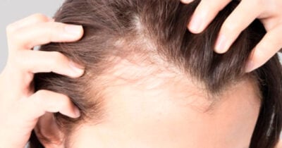 Calvície feminina tem solução com esses 5 cortes de cabelo (Foto: Divulgação)
