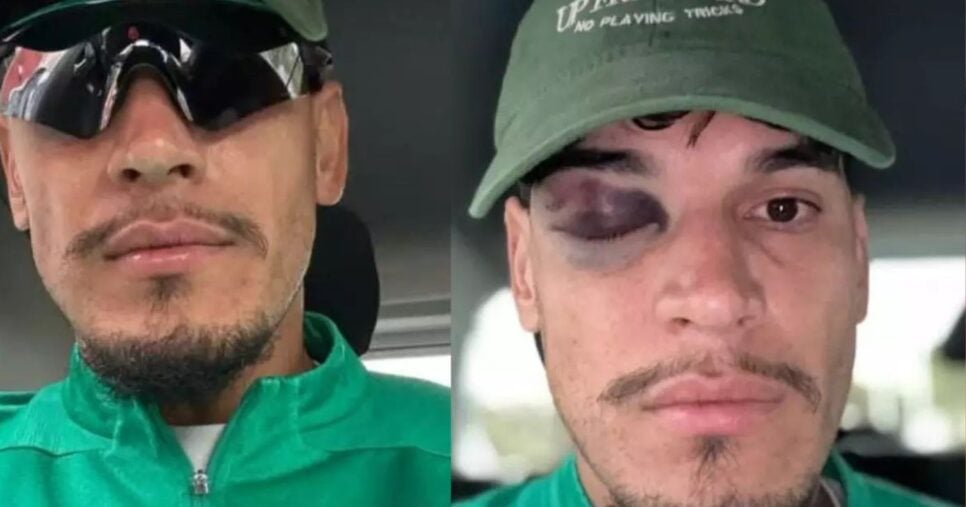 Gustavo Gómez posta foto com olho roxo - Foto: Instagram