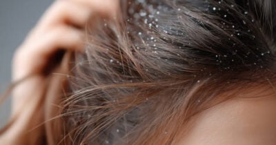 Essas são as 5 dicas que vão te ajudar a acabar com a caspa (Foto: Divulgação)