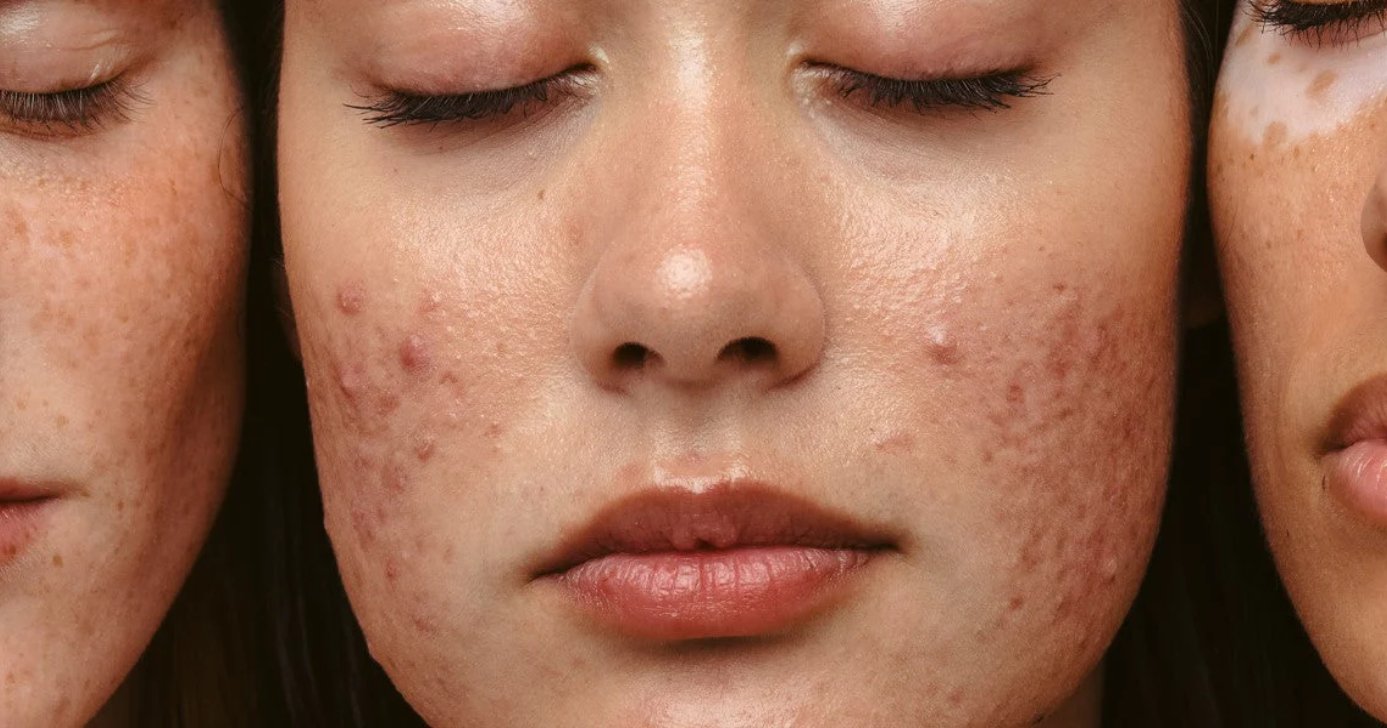 Espinhas são um problema na fase adulta (Foto: Divulgação)