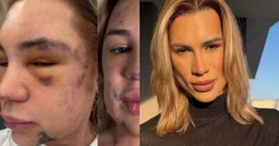 Famoso teve rosto deformado e fez 6 denúncias contra falso médico antes de morrer - Foto: Instagram