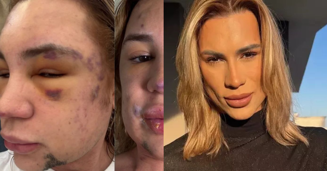 Famoso teve rosto deformado e fez 6 denúncias contra falso médico antes de morrer - Foto: Instagram