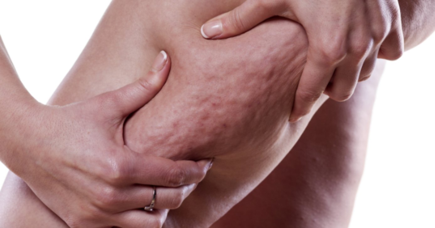 Celulite pode chegar ao fim com essas dicas (Foto: Divulgação)