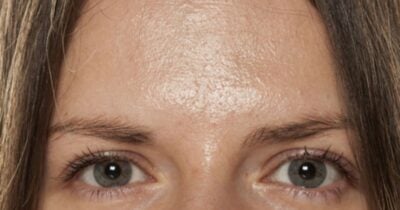 Mulher com a pele oleosa - Foto: Canva