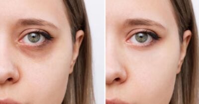 Mulher com e sem olheiras (Foto: Freepik)
