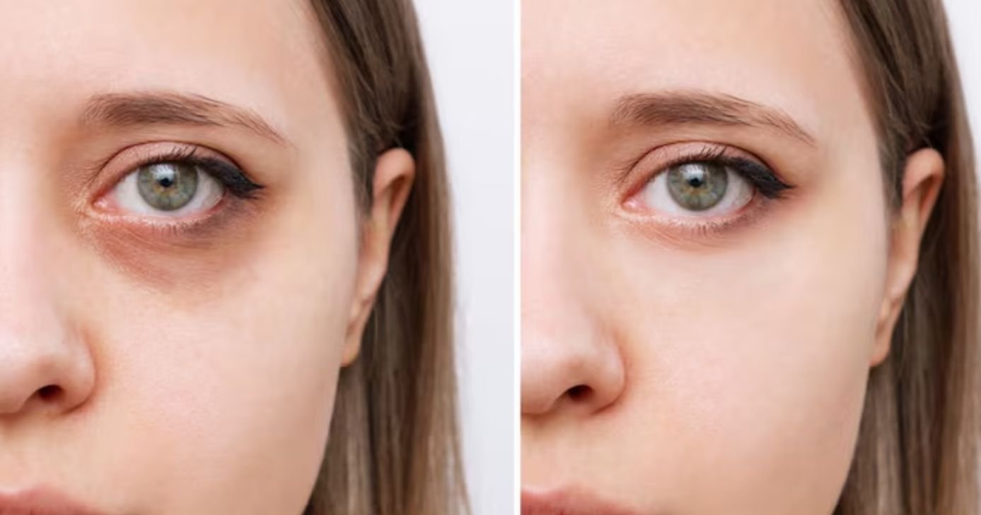 Mulher com e sem olheiras (Foto: Freepik)