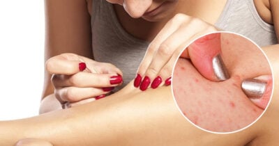 Pelos encravados (Foto: Reprodução)