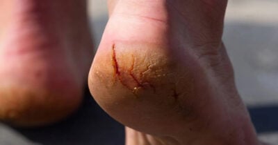 Pés rachados (Foto: Divulgação)