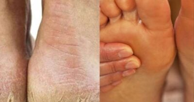 Receita para acabar com pés rachados - Foto: Montagem