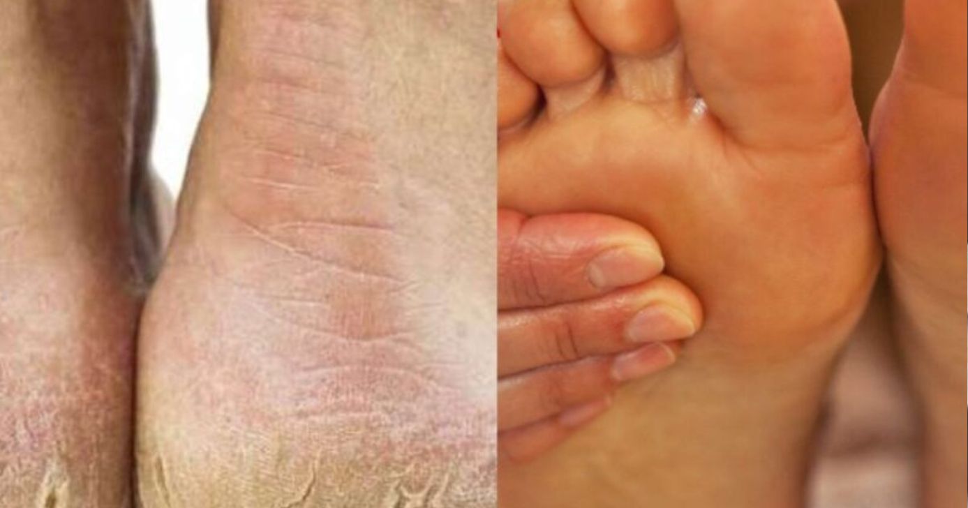 Receita para acabar com pés rachados - Foto: Montagem