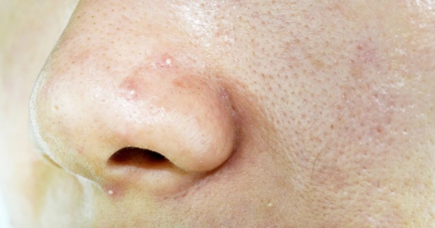 Como amenizar os poros dilatados da pele (Foto: Divulgação)